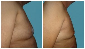 Απαλλάξου από τη γυναικομαστία και νιώσε όμορφα με το σώμα σου Απαλλάξου από τη γυναικομαστία και νιώσε όμορφα με το σώμα σου