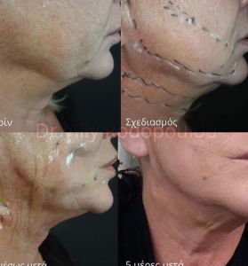 Πόσο διαρκεί το αποτέλεσμα μιας χειρουργικής επέμβασης;