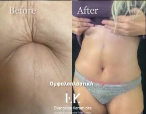 (VIDEO) Εμπειρίες ασθενών μας μετά από επεμβάσεις (VIDEO) Εμπειρίες ασθενών μας μετά από επεμβάσεις