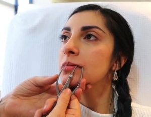 Fillers για νεανικά ζυγωματικά & πλούσια χείλη