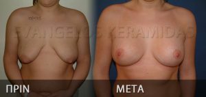 Αγαλμάτινο στήθος με τη No touch No pain τεχνική ανόρθωσης