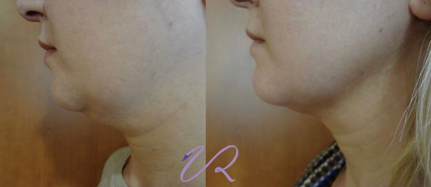 Ενέσιμη Λιποδιάλυση: Σμίλευση προσώπου και σώματος χωρίς χειρουργείο!