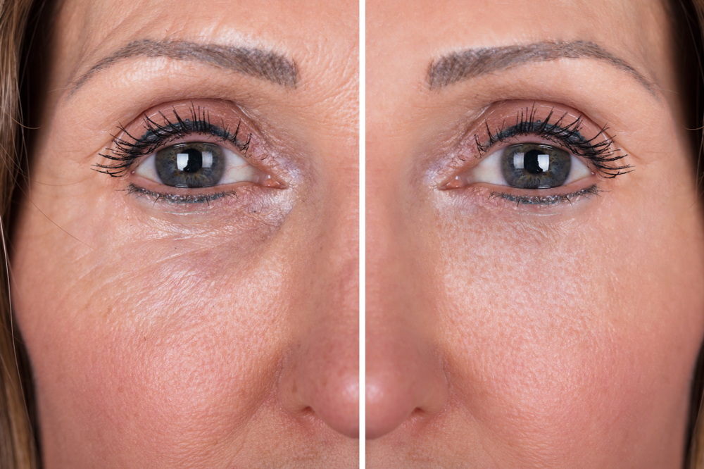 Infrared Full Face Rejuvenation: Ανανέωση στο πρόσωπο με τη δύναμη του φωτός!