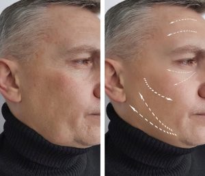 Infrared Full Face Rejuvenation: Ανανέωση στο πρόσωπο με τη δύναμη του φωτός!