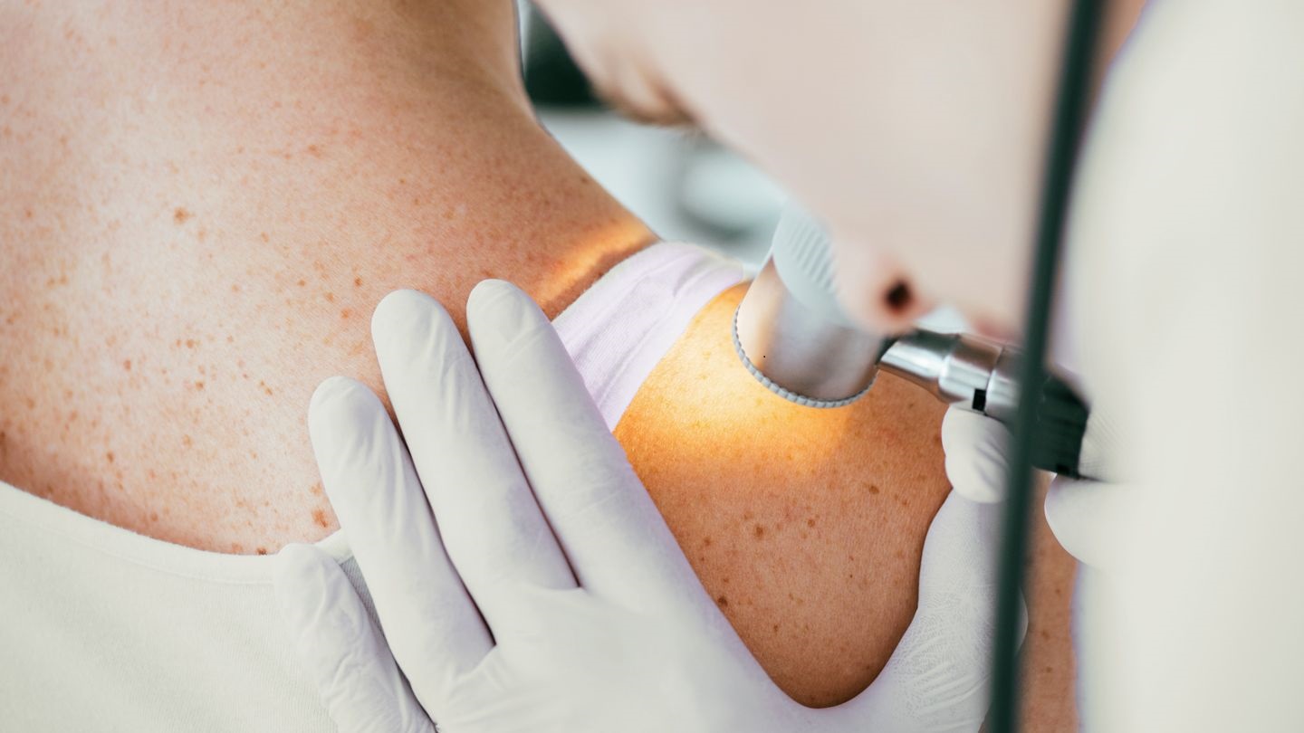 Μάιος: Μήνας επαγρύπνησης για τον καρκίνο του δέρματος