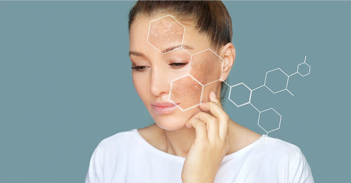 Πώς θα αποφύγω τις πανάδες φέτος το καλοκαίρι;