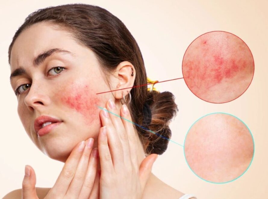 Απρίλιος – Παγκόσμιος μήνας ευαισθητοποίησης για τη Ροδόχρου Νόσο