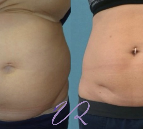 Κρυογλυπτικη-3D™