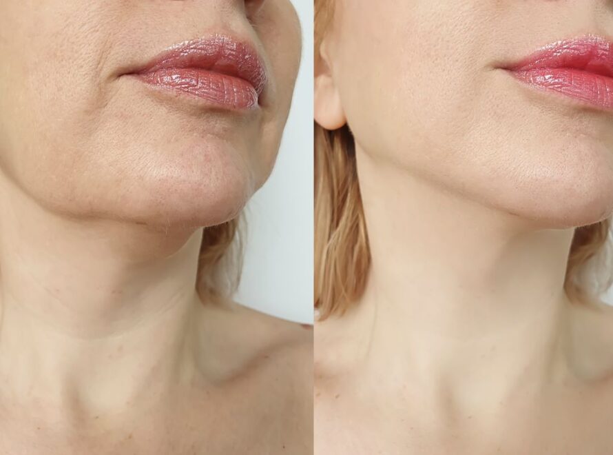 Σχεδιαζοντας ξανα το οβαλ του προσωπου