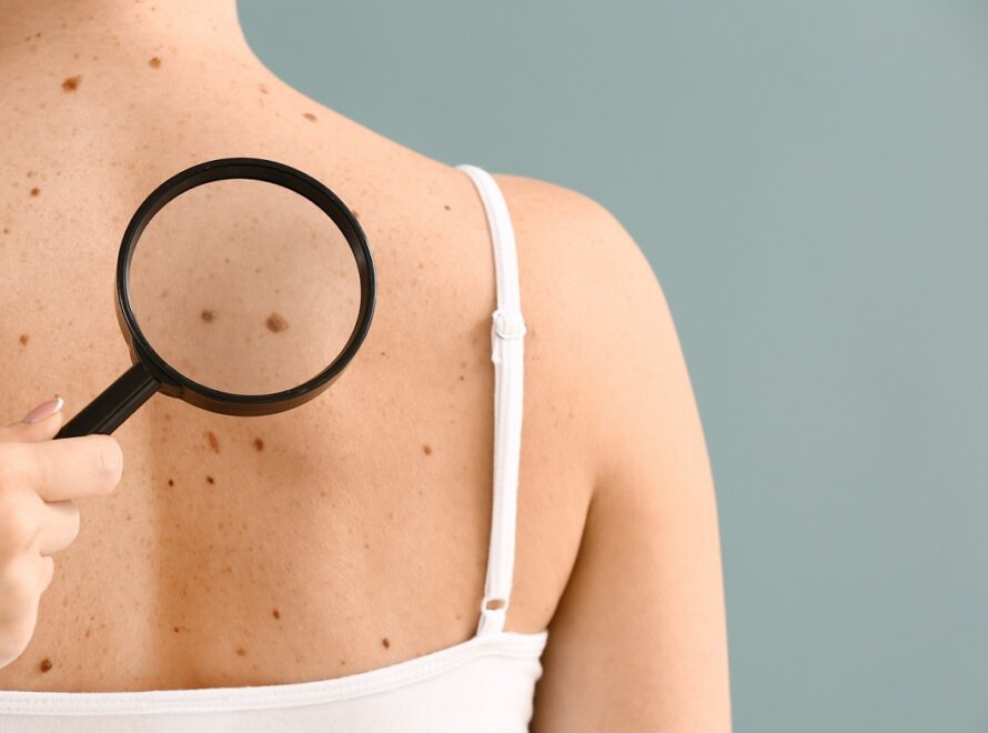 Ελεγχος σπιλων: Η εξεταση που πρεπει να κανετε