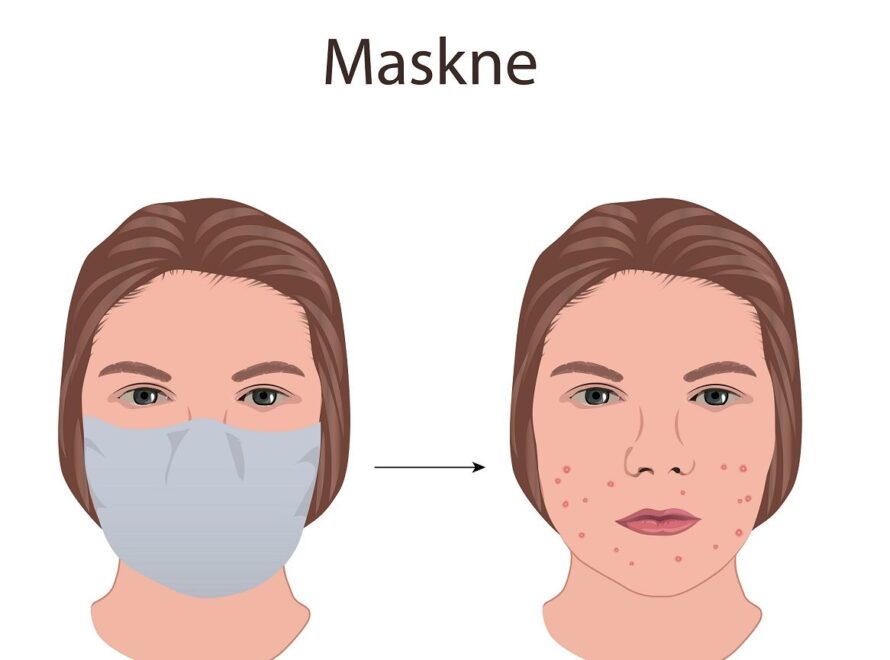 Maskne: Τα top συστατικά & οι ιατρικές θεραπείες για να νικήσουμε την ακμή από χρήση μάσκας!