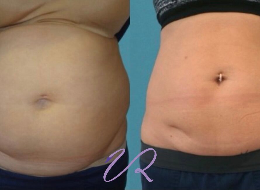 Κρυογλυπτικη-3D™: Η αναβαθμισμενη τεχνικη της κρυολιπολυσης-3D™