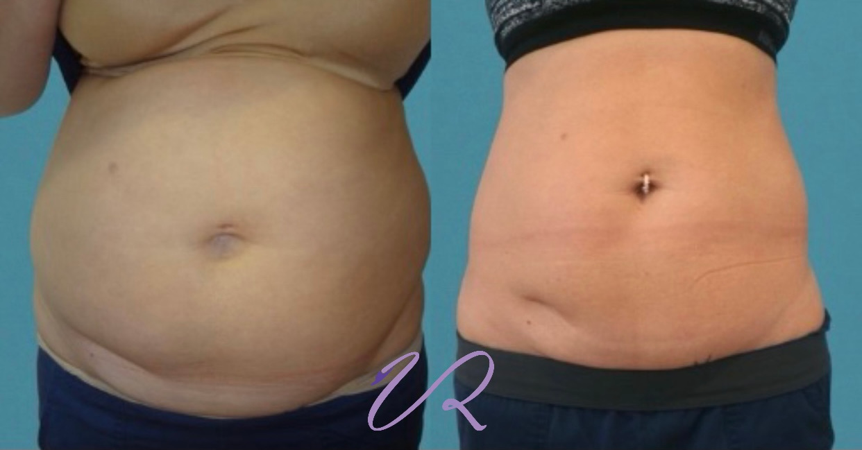 Κρυογλυπτικη-3D™: Η αναβαθμισμενη τεχνικη της κρυολιπολυσης-3D™ Κρυογλυπτικη-3D™: Η αναβαθμισμενη τεχνικη της κρυολιπολυσης-3D™