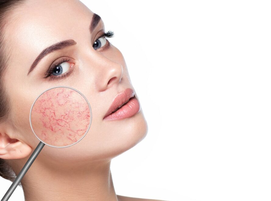 Θεραπειες για το ευαισθητο δερμα