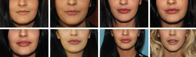 Step by step Φ technique™: Αποτελεσματα Ερευνων Για Τη Διεθνη Τεχνικη Μας Για Ιδανικα Χειλη Step by step Φ technique™: Αποτελεσματα Ερευνων Για Τη Διεθνη Τεχνικη Μας Για Ιδανικα Χειλη