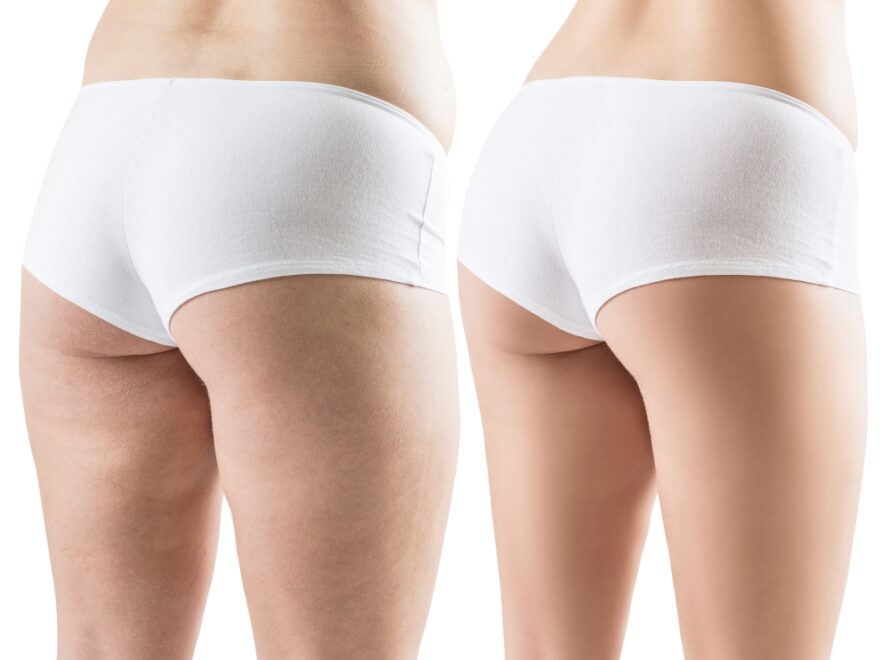 Συνδυαστική θεραπεία βάζει τέλος στο τοπικό πάχος και κυτταρίτιδα που επιμένουν