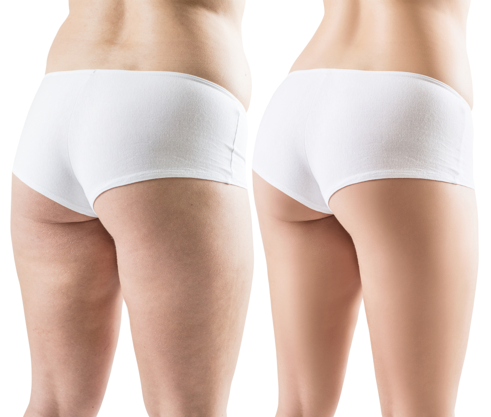 Συνδυαστική θεραπεία βάζει τέλος στο τοπικό πάχος και κυτταρίτιδα που επιμένουν