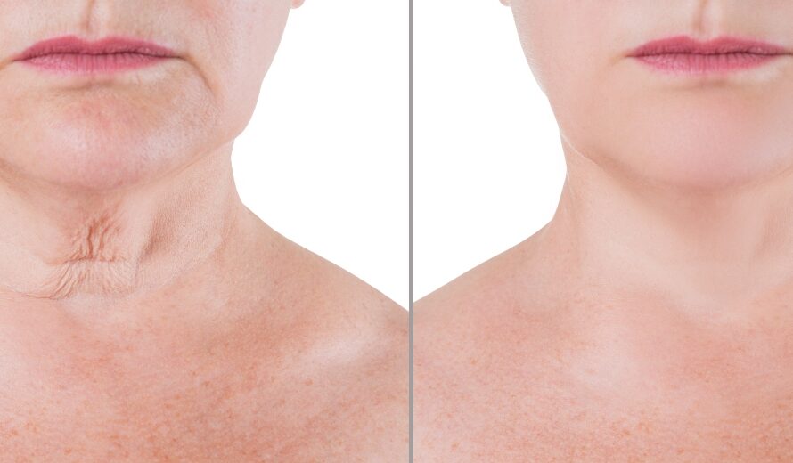 Tech Neck: Πρόωρη γήρανση λαιμού και smartphones: συνδέονται τελικά;