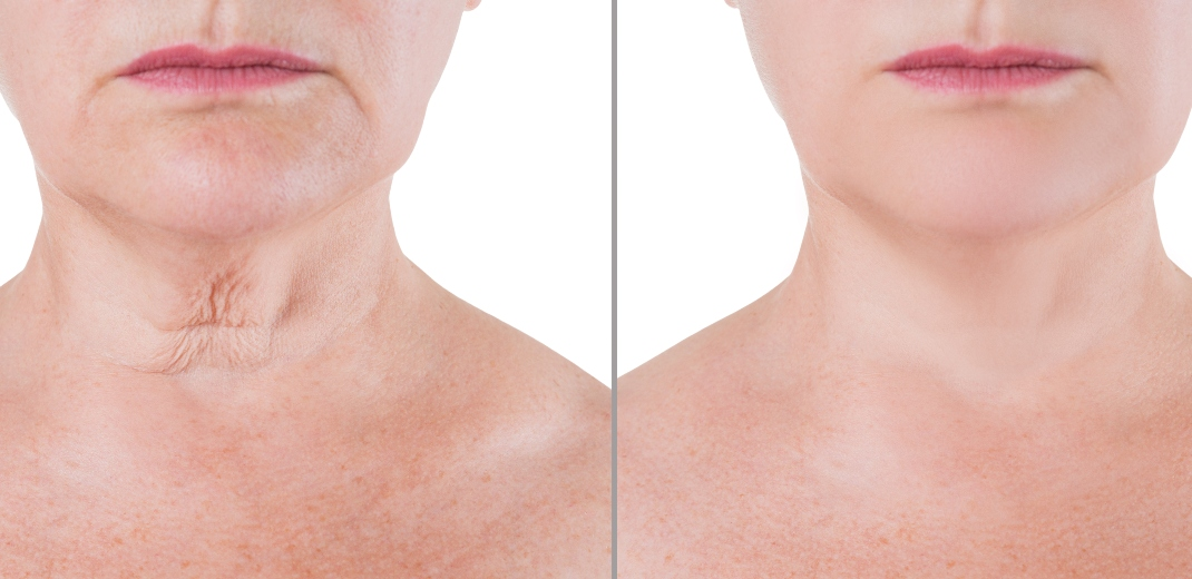 Tech Neck: Πρόωρη γήρανση λαιμού και smartphones: συνδέονται τελικά; Tech Neck: Πρόωρη γήρανση λαιμού και smartphones: συνδέονται τελικά;