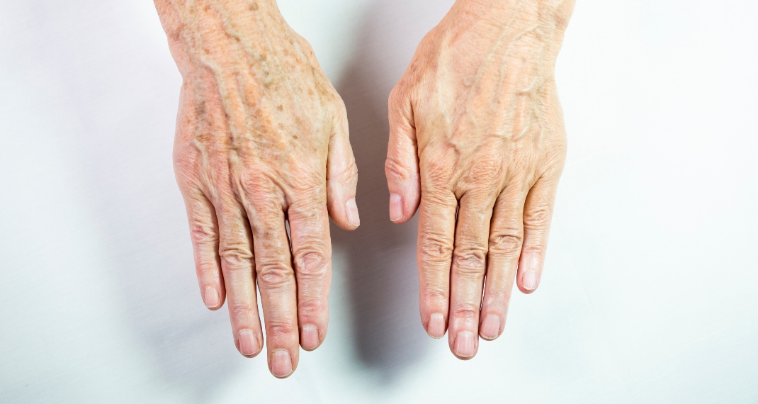 "Η ηλικία φαίνεται από τα χέρια" μία θεωρία που καταρρίφθηκε