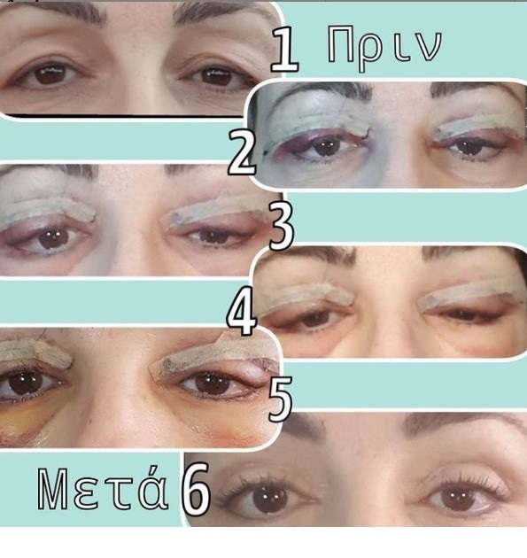 Τα πεσμένα βλέφαρα μπορούν να ανορθωθούν!