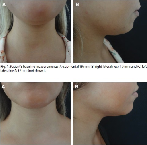 Κρυολιπόλυση- 3D™ : Η μέθοδος που κατοχυρώσαμε διεθνώς λιώνει ανώδυνα το λίπος