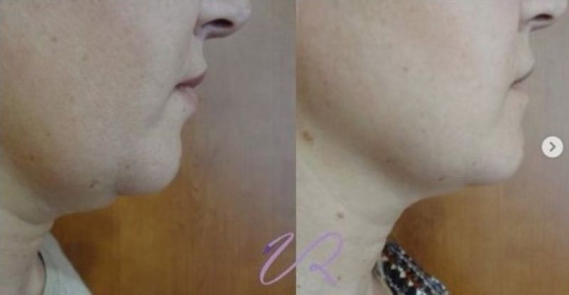 8 μη επεμβατικοί τρόποι ανόρθωσης του περιγράμματος του προσώπου