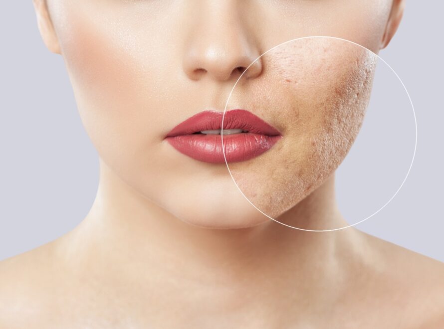 Πως εξαφανιζουμε τα σημαδια: Ολες οι θεραπειες και τα πιο εξυπνα δερμοκαλλυντικα