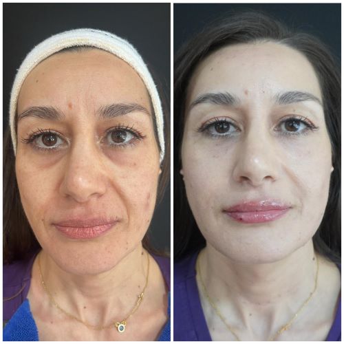 Golden Plasma Filler: Η εξέλιξη της Golden Touch, μία επανάσταση στο Κosmesis!