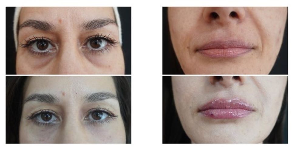 Golden Plasma Filler: Η εξέλιξη της Golden Touch, μία επανάσταση στο Κosmesis!