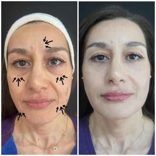 Ήρθε η επαναστατική Golden Plasma Filler, η πιο πρωτοποριακή, αναγεννητική, φυσική θεραπεία!