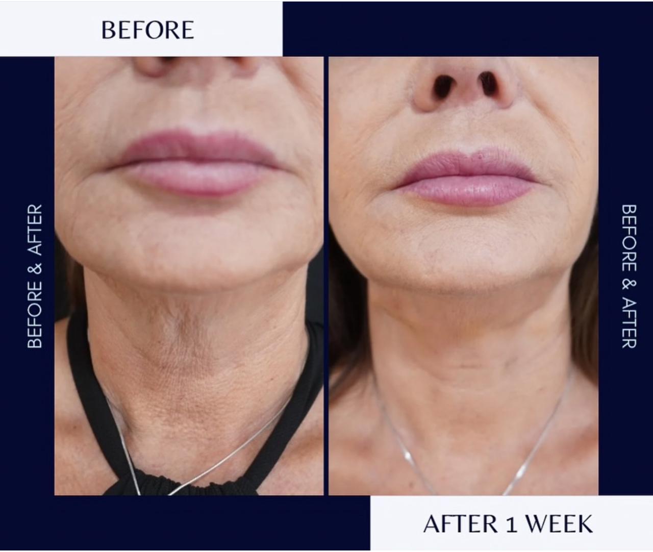 Νήματα Προσώπου: Άμεσο, ανώδυνο face lifting χωρίς χειρουργείο Νήματα Προσώπου: Άμεσο, ανώδυνο face lifting χωρίς χειρουργείο