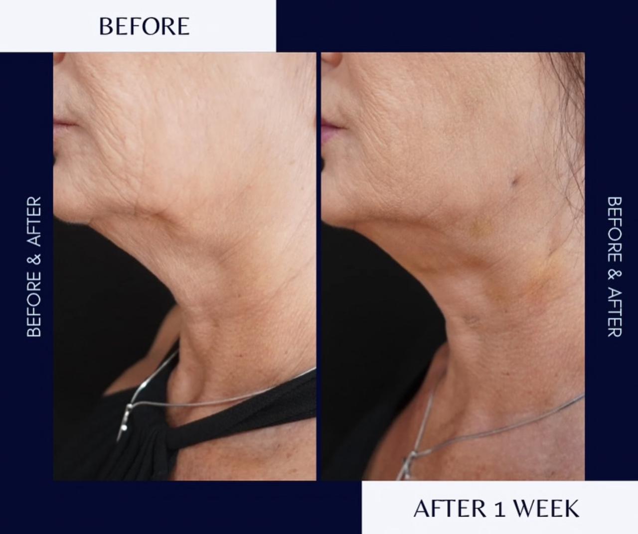 Νήματα Προσώπου: Άμεσο, ανώδυνο face lifting χωρίς χειρουργείο Νήματα Προσώπου: Άμεσο, ανώδυνο face lifting χωρίς χειρουργείο