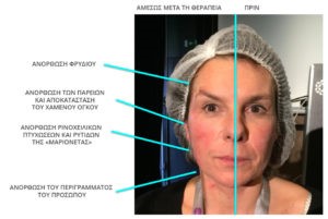 Νήματα Προσώπου: Άμεσο, ανώδυνο face lifting χωρίς χειρουργείο Νήματα Προσώπου: Άμεσο, ανώδυνο face lifting χωρίς χειρουργείο