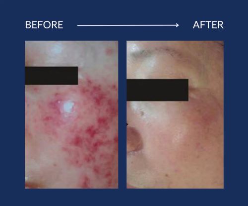 Λιπαρό δέρμα με ακμή: Υπάρχει η ρουτίνα που δίνει τη λύση! Λιπαρό δέρμα με ακμή: Υπάρχει η ρουτίνα που δίνει τη λύση!