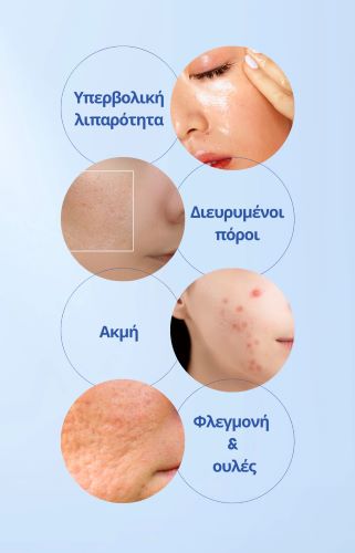 Λιπαρό δέρμα με ακμή: Υπάρχει η ρουτίνα που δίνει τη λύση! Λιπαρό δέρμα με ακμή: Υπάρχει η ρουτίνα που δίνει τη λύση!