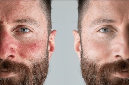 Ας μιλήσουμε ανοιχτά για τη Ροδόχρου Νόσο!