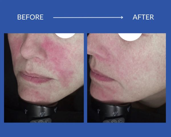 Rosacea Awareness Month: Η επιστήμη πίσω από το «κόκκινο» του προσώπου και η medi-grade λύση