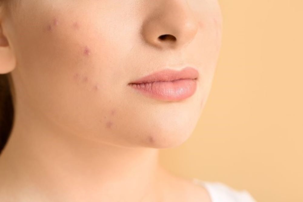 Acne Awareness Month: Ο απόλυτος οδηγός για καθαρή επιδερμίδα χωρίς ατέλειες και διεσταλμένους πόρους
